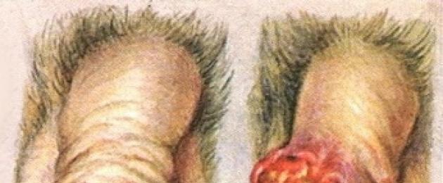 Наросты на головке у мужчин. Кандиломатоз — это остроконечные кондиломы у мужчин на половом члене: симптомы и фото бородавки. Вирус имеет несколько подтипов.