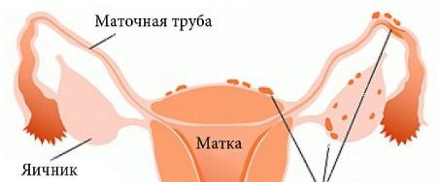 Симптомы и лечение эндометриоза матки у женщин. Женские болезни в гинекологии: эндометриоз