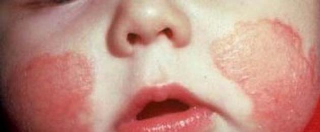 Orticaria allergica da ciò che accade.  Cosa causa l'orticaria?