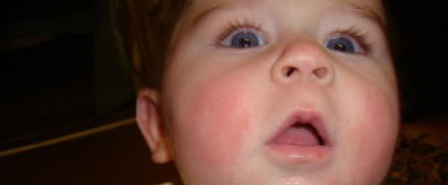 Ребенка покраснели щеки что. Почему у ребенка краснеют щеки? Прорезывание зубов