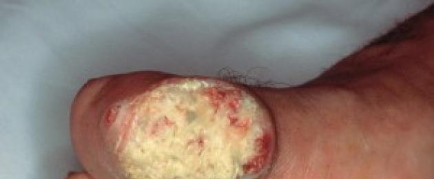 Причины, симптомы и лечение рака пальца. Как определить начальную стадию рака кожи? Онко опухоль на руке