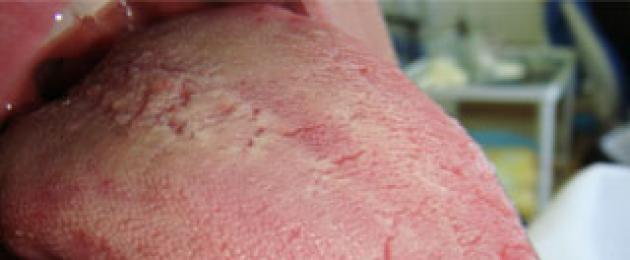 Quali elementi della lesione sono caratteristici della stomatite allergica.  Stomatite allergica: cause, sintomi, trattamento
