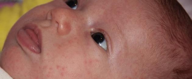 Красные пятна на лице: причины у женщин, мужчин и детей. Сухие пятна на коже ребенка: причины развития, симптомы и лечение заболевания