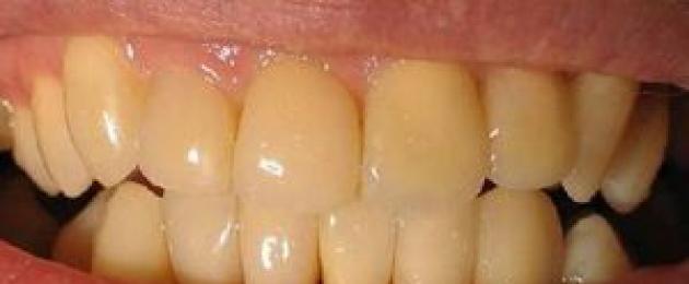 В каких случаях и зачем проводят процедуру реминерализации зубной эмали? Как проводится реминерализация зубов в стоматологии и дома? Глубокая минерализация зубов. 