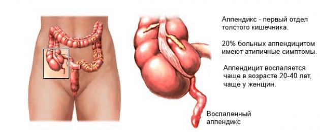Possibili complicanze postoperatorie precoci nell'appendicite.  Complicazioni di appendicite
