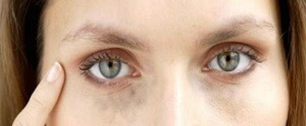 Синяки под глазами: причины появления, методы лечения. Почему возникают синяки под глазами у женщин