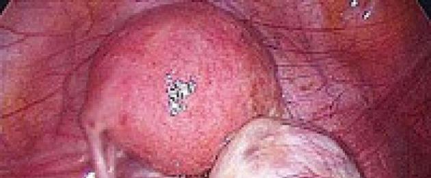 Эмбриональная опухоль желточного мешка. Хориокарцинома, эмбриональная карцинома и другие опухоли яичка