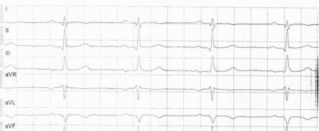 Инфаркт на экг — признаки и расшифровка. Признаки и стадии инфаркта миокарда на экг Об инфаркте миокарда на экг указывает