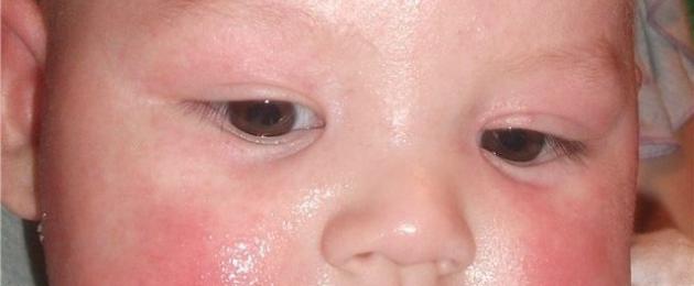 Почему у малыша красные щечки комаровский. Вирусы и инфекции