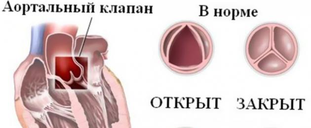 Cambiamenti degenerativi nella valvola aortica.  Cambiamenti degenerativi nei lembi della valvola aortica