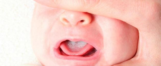 Цветет во рту у новорожденного что делать. Как вылечить молочницу во рту у младенца? У грудничков заболевание может возникнуть