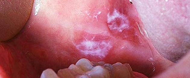 Болячка на внутренней стороне губы чем лечить. ﻿ Язвочки во рту и болячки: причины и лечение в домашних условиях