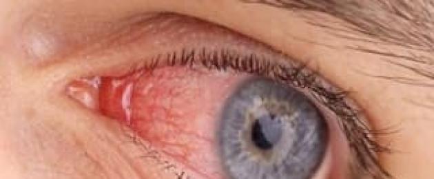 После умывания краснеют глаза. Почему краснеют глаза? Профилактика и лечение покраснения глаз после бани