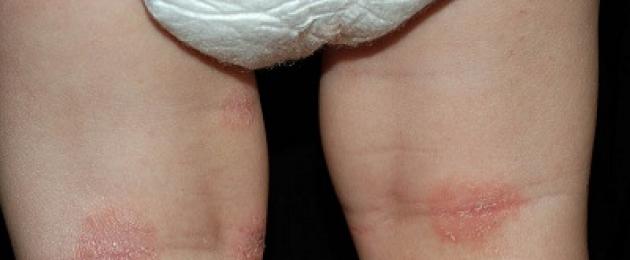 التهاب الجلد التقشري ريتر وأنواع أخرى من التهاب الجلد عند الأطفال حديثي الولادة.  التهاب الجلد التحسسي عند الرضع - ما يجب القيام به.