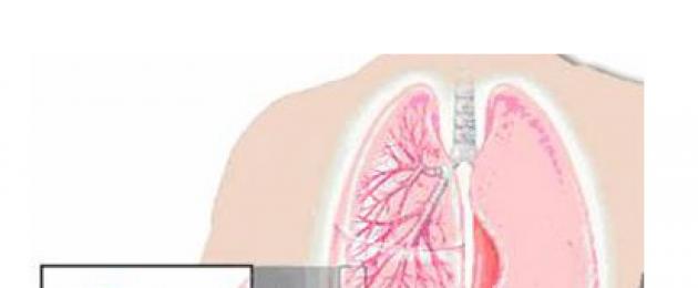 Дыхательная недостаточность у детей и взрослых - виды, причины, симптомы, диагностика, лечение. Дыхательная недостаточность (Легочная недостаточность) Памятка на тему острая дыхательная недостаточность