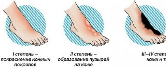 Что делать, если отморозил пальцы ног. Обморожение пальцев ног