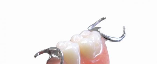 Зубные протезы-бабочки и важные нюансы протезирования с их помощью. Микропротезирование отсутствующего зуба
