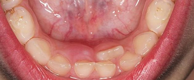 Появление второго ряда зубов у ребенка: причины и исправление дефекта. Зубы второго ряда: причины возникновения аномалий