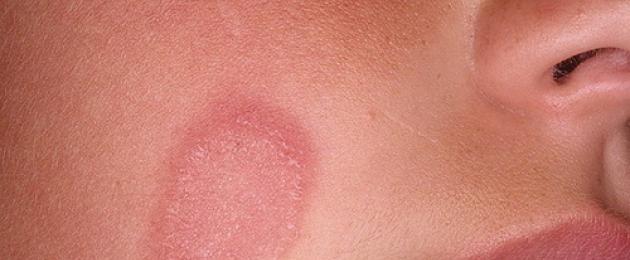 Болезни кожи лица: можно ли вовремя распознать опасность? Эпидермальный стафилококк на коже лица.