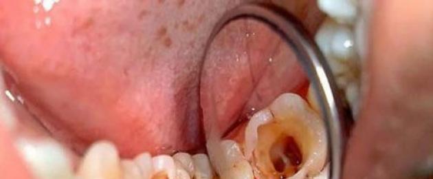 Почему болит зуб после пломбирования каналов? Боль в зубе после пломбирования. 