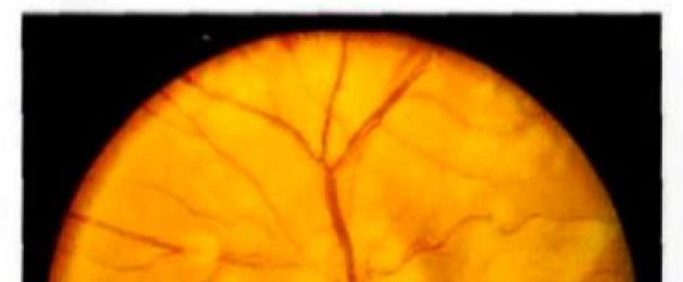  Застойный диск зрительного нерва: причины и лечение заболевания. Псевдозастойный диск зрительного нерва