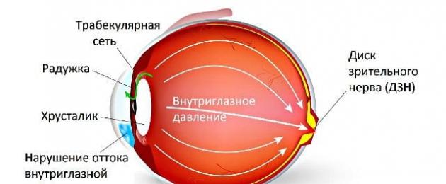 Ipertensione oculare essenziale.  Ipertensione oculare e glaucoma