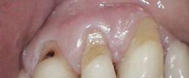 Оголенные основания зуба. Если оголилась шейка зуба, что делать