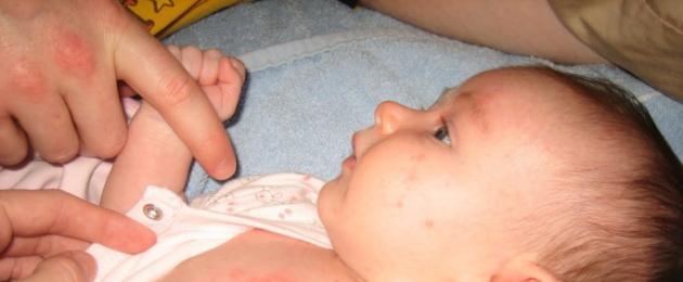 Вирусная сыпь у детей. Симптомы вирусной и внезапной экзантемы у детей: фото сыпи и принципы лечения кожной инфекции
