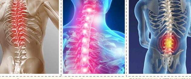 Osteocondrosi lombare: come determinare questa malattia.  Radici spinali e arterie