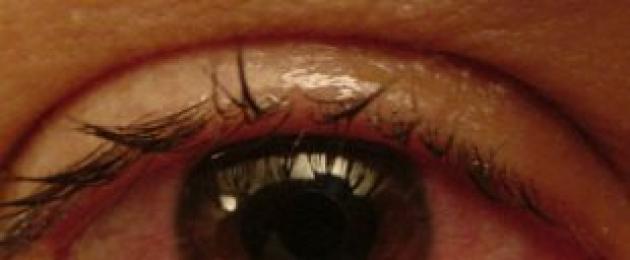 تفاقم التهاب القزحية.  التهاب القزحية (التهاب شبكة الأوعية الدموية في العين): الصور والأعراض والعلاج
