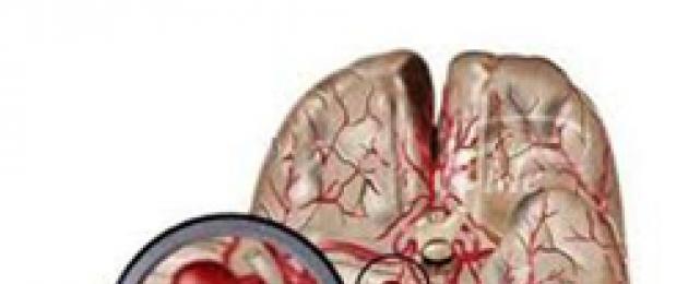 Признаки и лечение аневризмы сосудов головного мозга. Аневризма