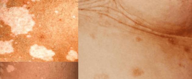 أنواع الطفح الجلدي عند الأطفال: صور للطفح الجلدي على الصدر والظهر وفي جميع أنحاء الجسم مع الشرح.  كيف نفهم أي نوع من الطفح الجلدي يعاني منه الطفل؟  طفح جلدي أحمر صغير في جميع أنحاء الجسم