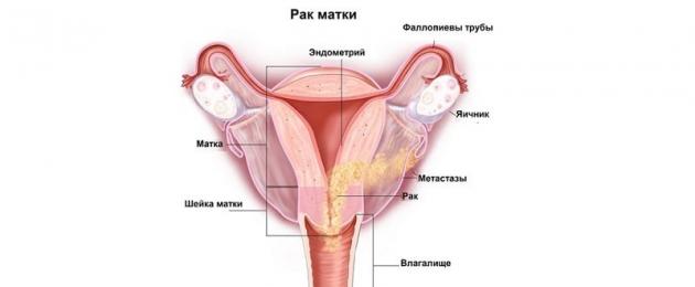Первые признаки рака матки на ранней стадии. Рак матки, стадии, симптомы, лечение