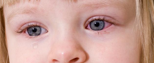 Что означает синева под глазами у детей. Бледность кожи и синяки под глазами у ребенка