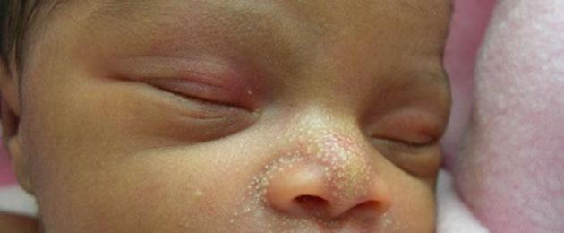 Золотистый стафилококк у грудничка на лице. Стафилококк в кале у ребенка: что это такое, признаки и симптомы заболевания, его терапия