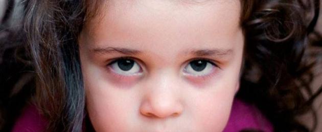 Cerchi bluastri sotto gli occhi di un bambino.  Lividi sotto gli occhi nei bambini: cause e cosa fare