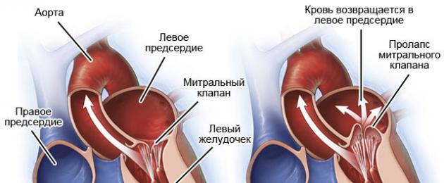 Заболевание пролапс митрального клапана. Все о пролапсе клапанов сердца и их лечении