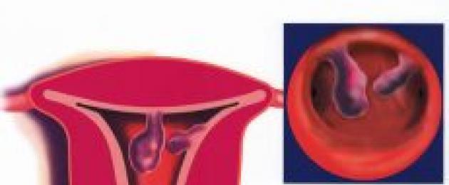 Лечение и восстановление здоровья после удаления полипа эндометрия в матке. Реабилитационный период после удаления полипа эндометрия