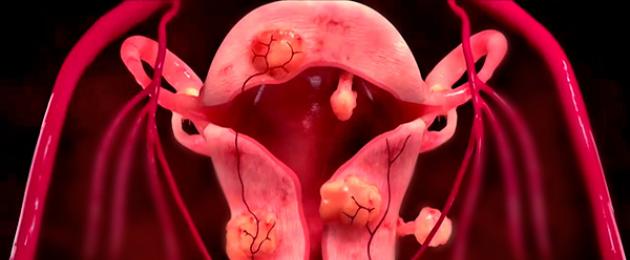 Рождение миомы после эмболизации. Эмболизация маточных артерий