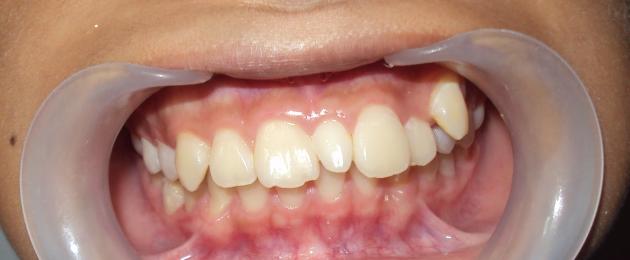 Dente soprannumerario: problema o vantaggio?  Un dente nel cielo come una sorta di anomalia.