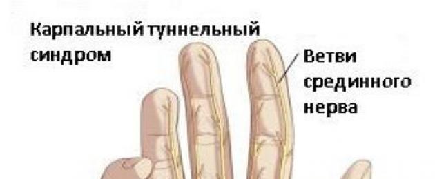 Немеют мизинец и безымянный пальцы на руке. Причины онемения среднего, указательного, большого, мизинца и безымянного пальца правой и левой руки
