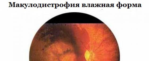 Дистрофия сетчатки глаза: обзор современных методов лечения. Симптомы при возрастной макулярной дегенерации