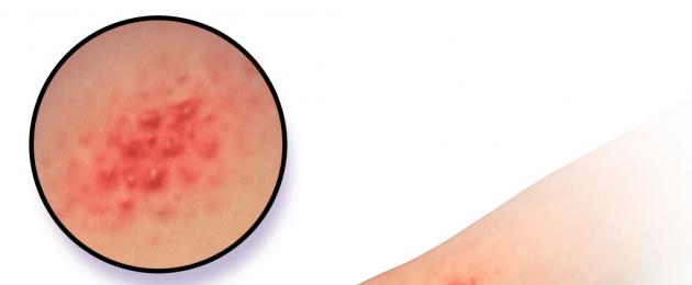 Сильный дерматит на руках чем лечить. Атопический дерматит на пальцах рук — Аллергия