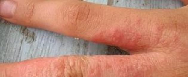 Гель от аллергии на коже. Аллергия на руках, виды, способы лечения