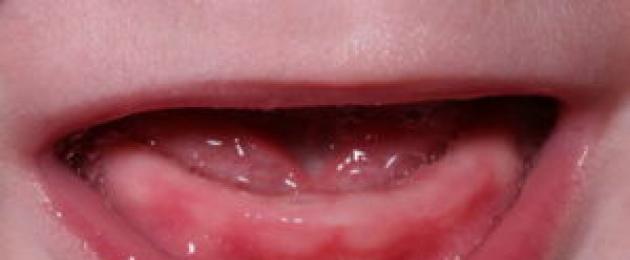 Во сколько у ребенка режутся зубы. Как проходит прорезывание зубов у детей