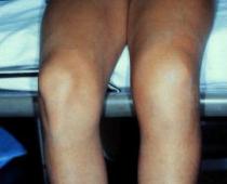 Травмы коленного сустава: симптомы и лечение