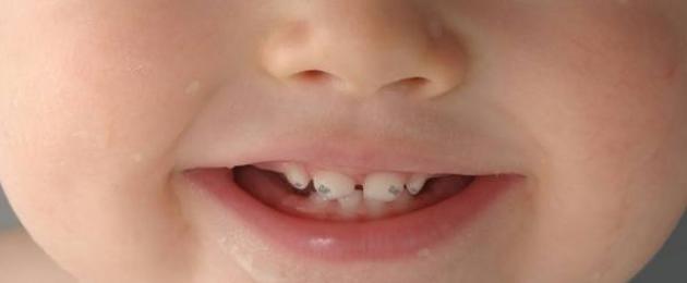 Пятна на зубах: причины появления и методы лечения. Удаление пятен на зубах