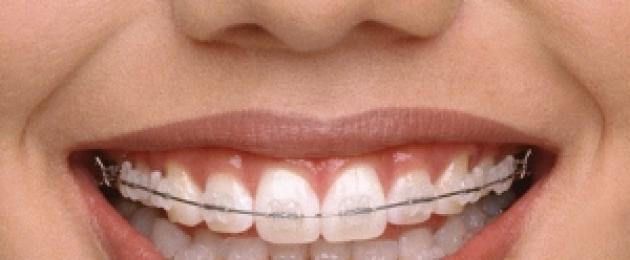 Как выровнять зубы в домашних. Как можно выровнять зубы в домашних условиях без участия ортодонта? Самыми распространенными являются