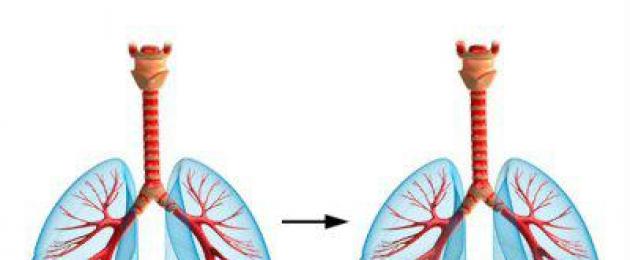 Si nota edema polmonare.  L’edema polmonare può essere curato?