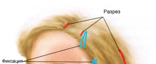 Эндоскопическая подтяжка средней трети лица. Эндоскопическая подтяжка лица – лучшая альтернатива пластической операции